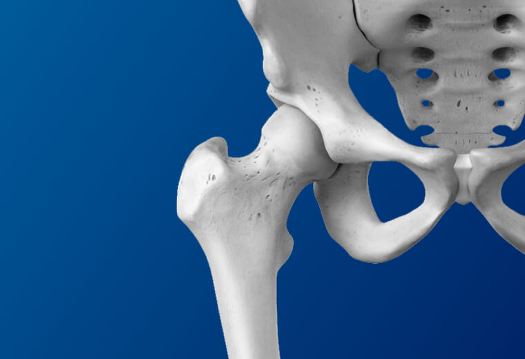 Arthrose de la hanche