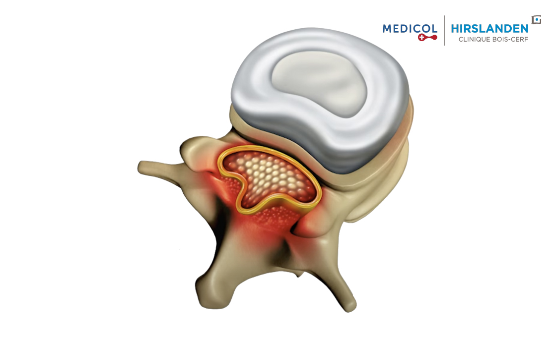 Décompression d'un canal lombaire étroit