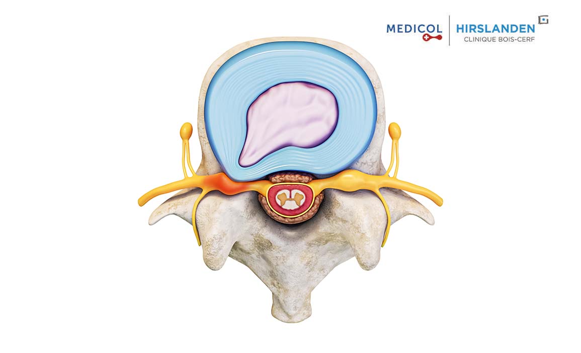 Prise en charge de l'hernie discale en radiologie interventionnelle en 2022