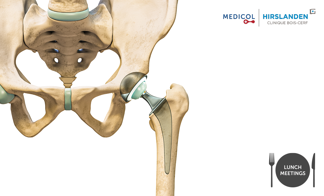 Actualités en chirurgie prothétique de la hanche: planification, tiges courtes et rééducation