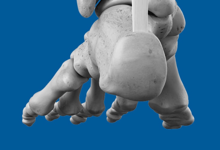 Hallux limitus fonctionnel