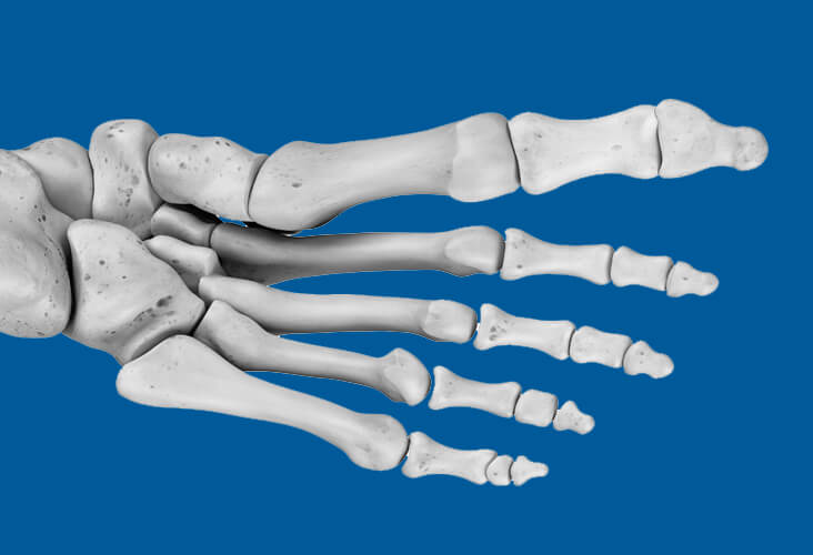 Hallux valgus