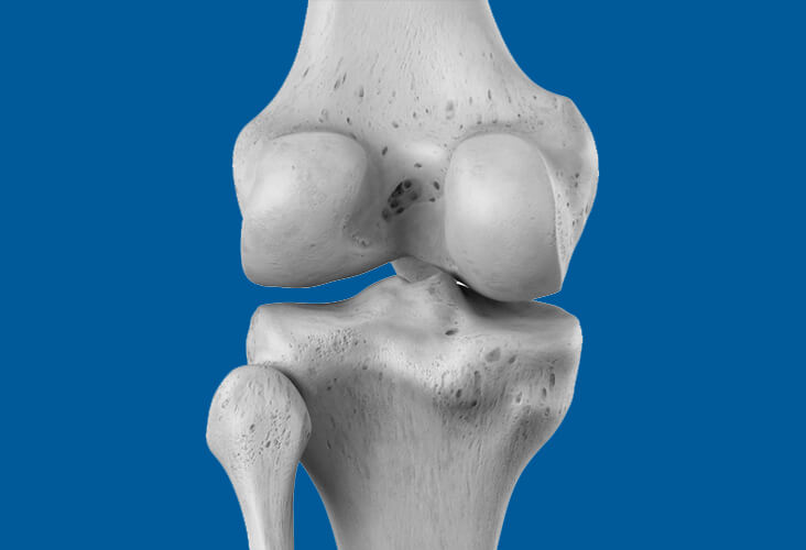 Lésions des ménisques