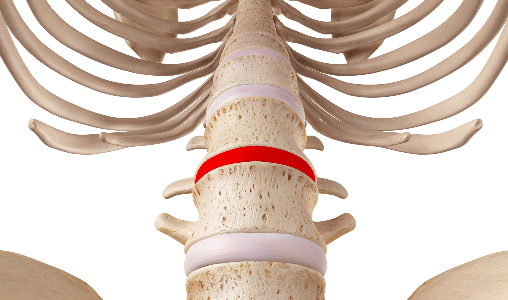 Hernie Discale Lombaire