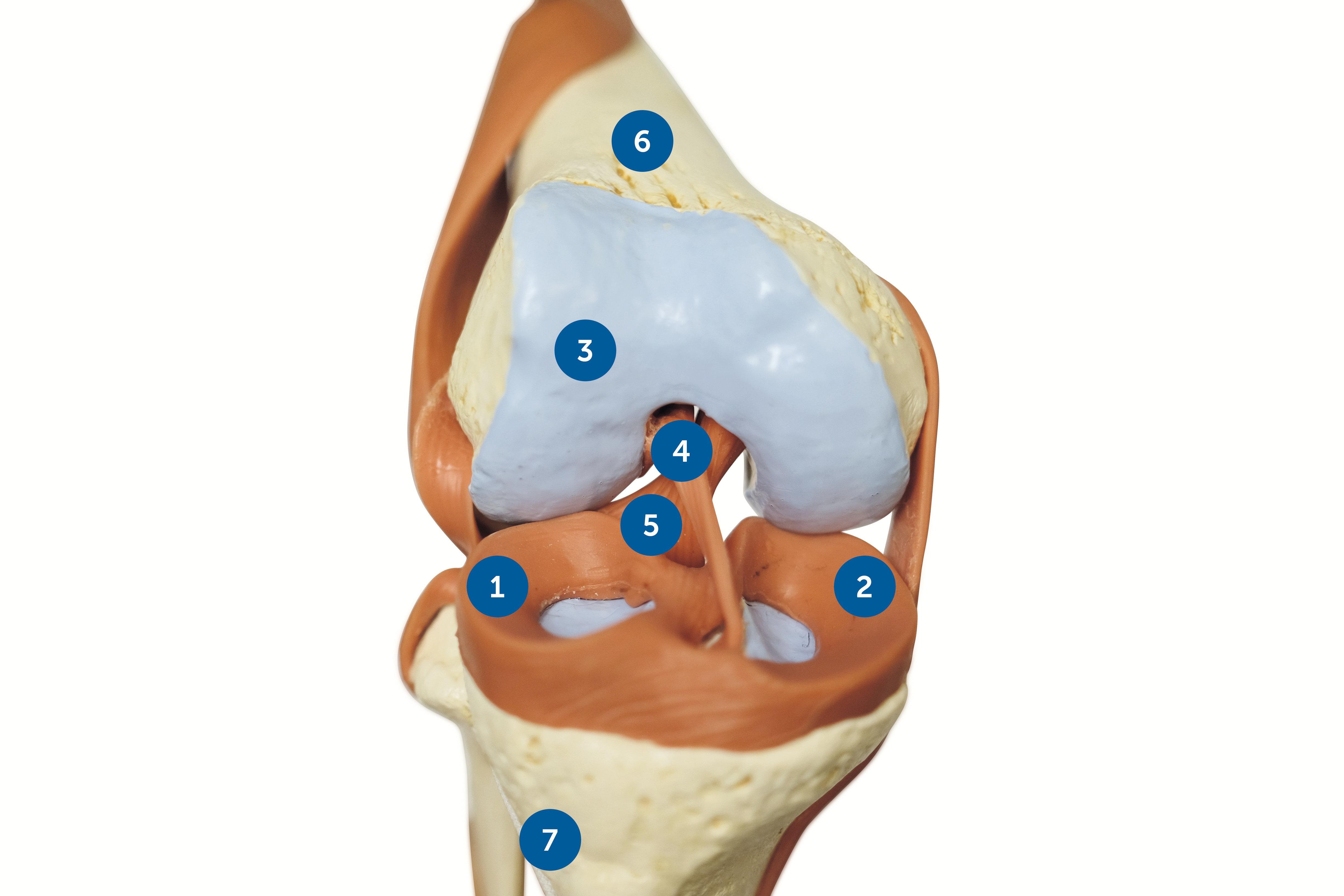 Lesion des ménisques