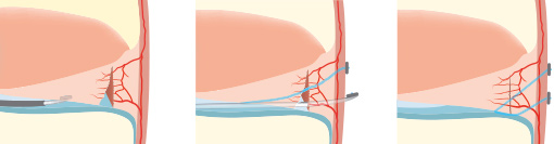 Lesion des ménisques