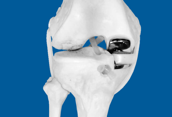 Prothèse unicompartimentale de genou