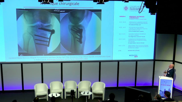 Chirurgie de transplantation méniscale avec guides de coupe sur mesure