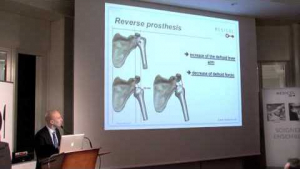L&eacute;sions de la coiffe des rotateurs: de la r&eacute;paration &agrave; la proth&egrave;se