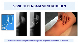 &Eacute;pid&eacute;miologie clinique et d&eacute;cryptage des douleurs de genou, nouvelle approche du syndrome rotulien