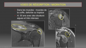 Prise en charge radiologique des tendinopathies calcifiantes de la coiffe des rotateurs: du diagnostic au traitement