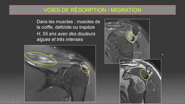 Prise en charge radiologique des tendinopathies calcifiantes de la coiffe des rotateurs: du diagnostic au traitement