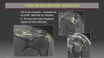 Prise en charge radiologique des tendinopathies calcifiantes de la coiffe des rotateurs: du diagnostic au traitement