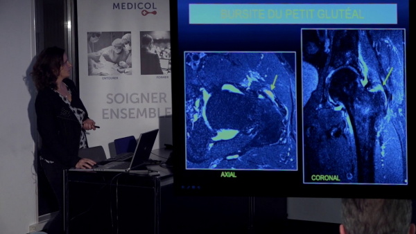 Les tendinopathies d&#039;insertion des fessiers ou lésions de la coiffe de la hanche