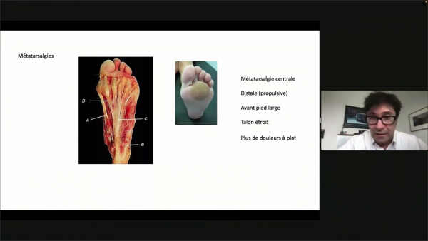 Brièveté des gastrocnémiens