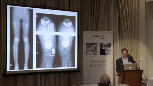 Genou: la fémoro-patellaire