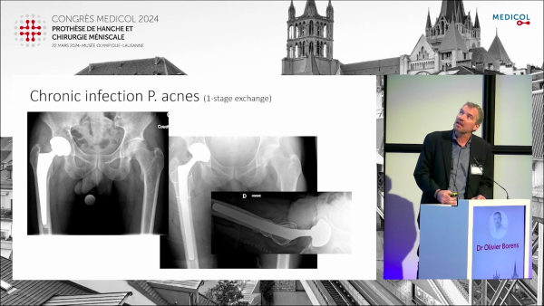 Les reprises chirurgicales