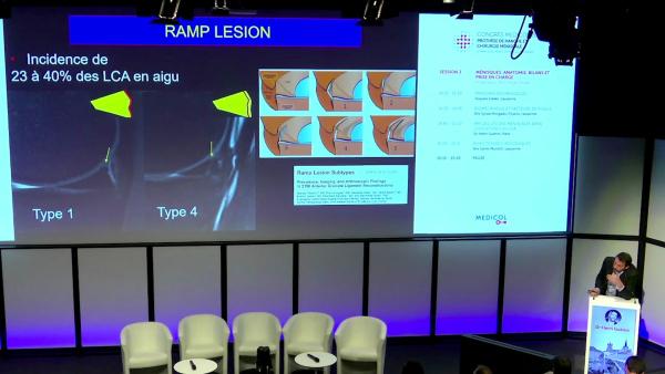 IRM des lésions méniscales dans les ruptures du LCA