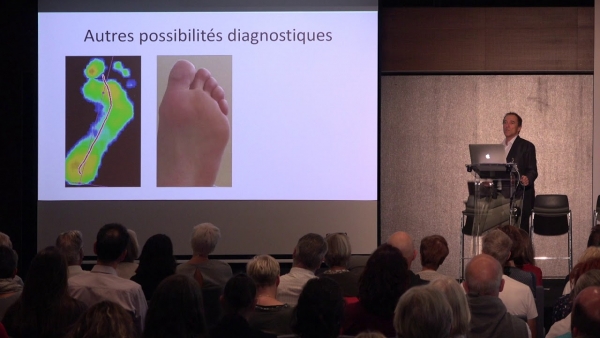 Hallux limitus fonctionnel (HLF): implication du HLF dans les troubles de la marche et de la posture