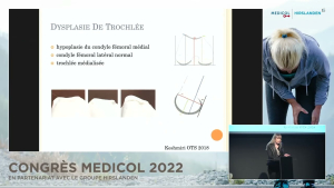 La dysplasie trochl&eacute;enne