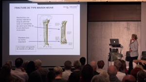 L'instabilit&eacute; chronique de cheville, origine(s), pr&eacute;vention, traitement