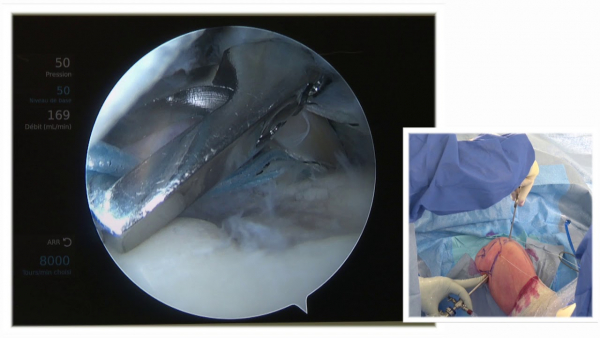 Workshop rééducation de l&#039;épaule