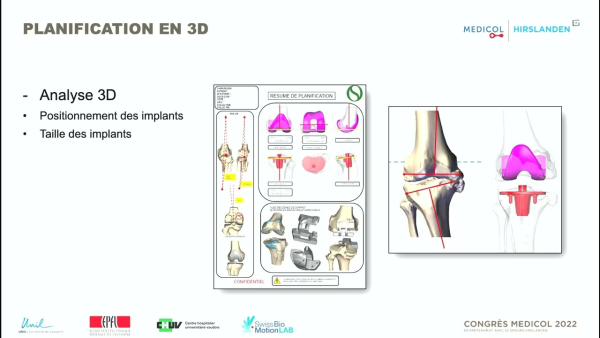 La planification 3D pré-opératoire est-elle encore d'actualité?