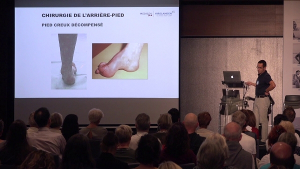 Bénéfices de la physiothérapie dans la chirurgie de l'arrière-pied en postopératoire