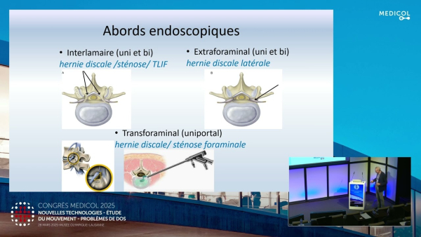 Le renouveau de l'endoscopie rachidienne