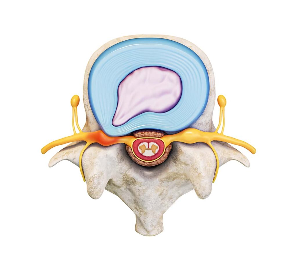 La hernie discale - diagnostic et alternative de traitement - Lausanne