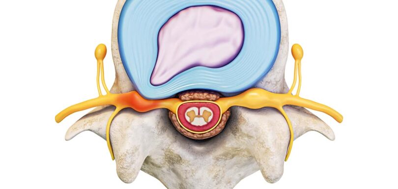 La hernie discale - diagnostic et alternative de traitement - Lausanne