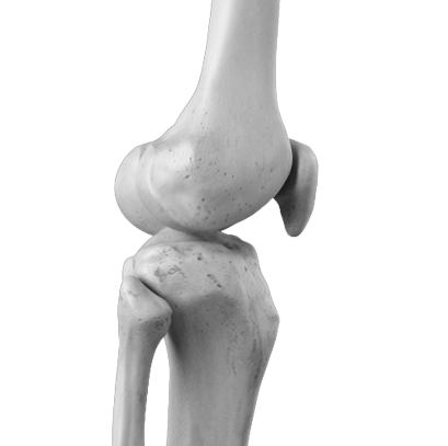 Arthrose du genou