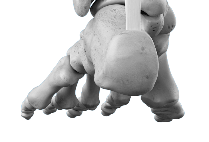 Hallux limitus fonctionnel