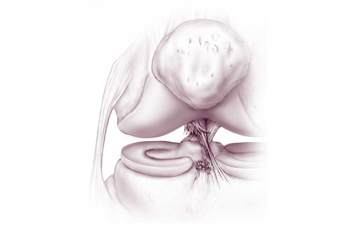 Genou - acl-tear