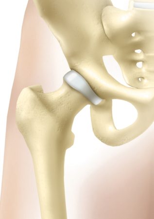 L_arthrose_de_la_hanche_01