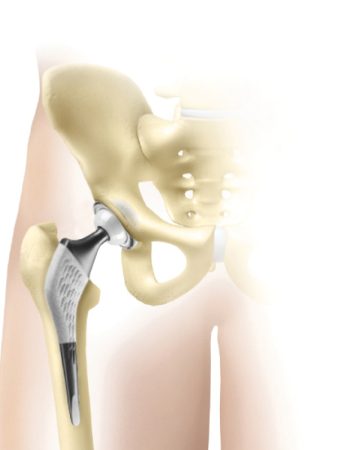 L_arthrose_de_la_hanche_02