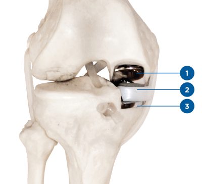 arthrose_du_genou_06